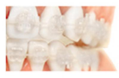 Saphir artificiel: Centre dentaire la plaine saint denis