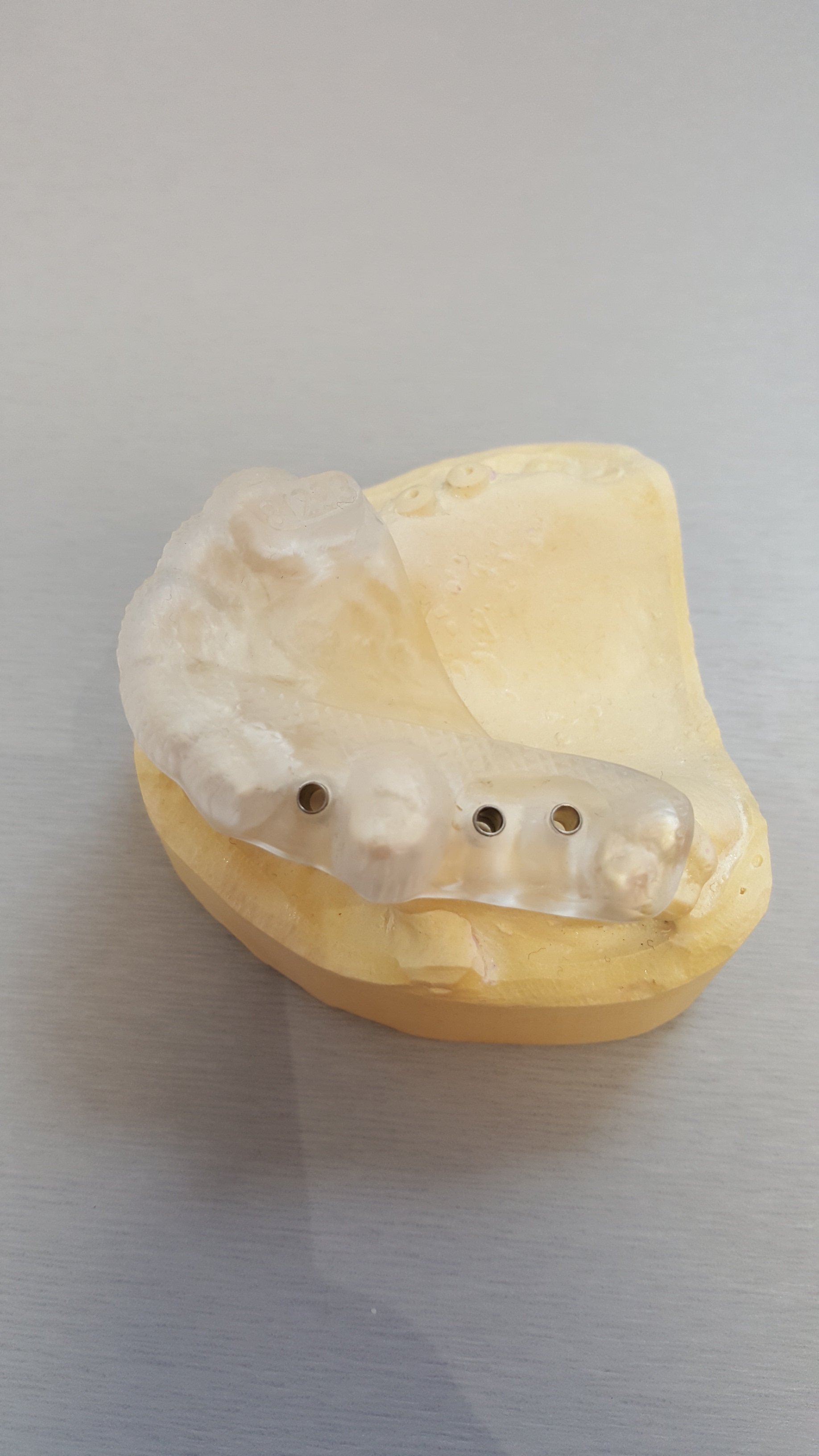 Implant dentaire Aubervilliers