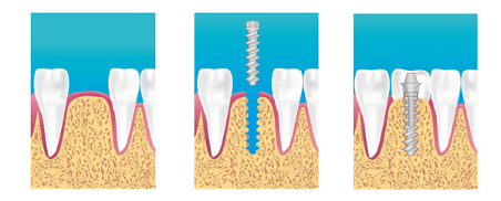 Implant dentaire Aubervilliers