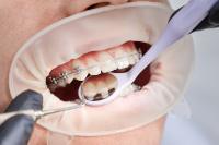 Pose d'un appareil orthodontique Centre Dentaire La Plaine Sanit Denis-Dentora